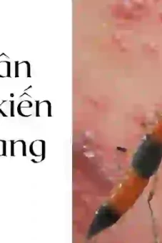 Mẹo dân gian trị kiến ba khoang đốt được chia sẻ nhiều